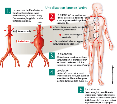 L’enjeu du dépistage de l’anevrisme de l’aorte